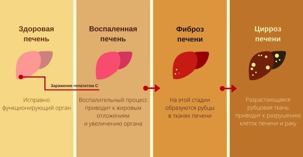 Гепатит С в Москве – запись к врачу и лечение в ФНКЦ ФМБА России